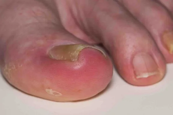 Pedicure bij voet- en nagelklachten – Den Haag